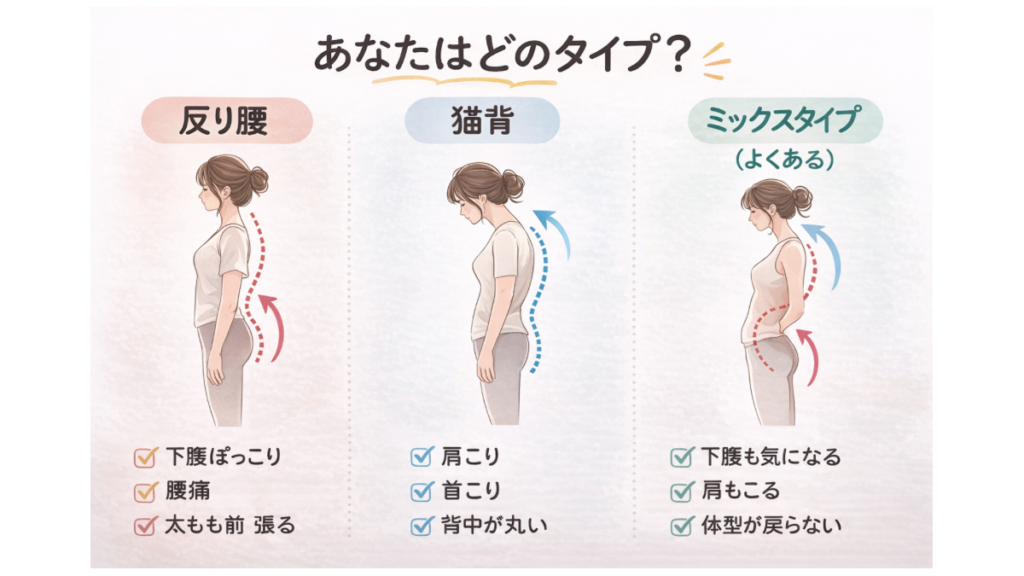 産後の姿勢崩れチェック｜反り腰・猫背・ミックスタイプを比較したシルエット図解